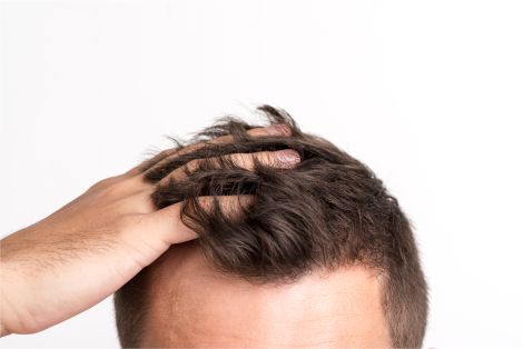 Doenças do Couro Cabeludo, Queda de Cabelo, Alopecia ou Calvície