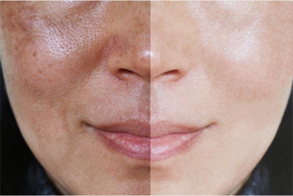 Manchas Solares e Melasma